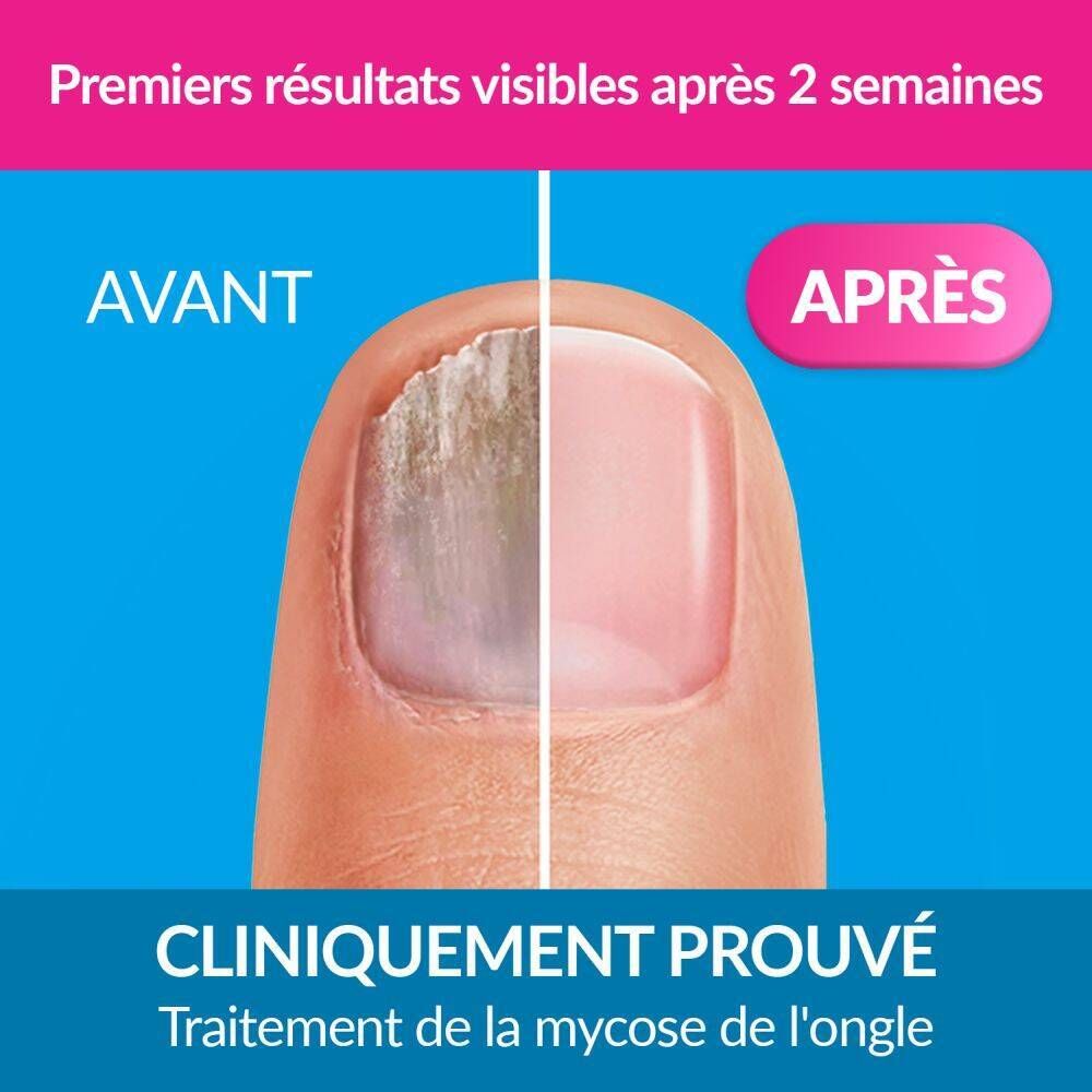 EXCILOR Solution Traitement de la Mycose de l'Ongle