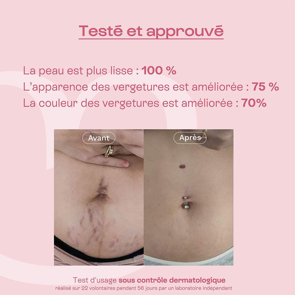 Comparaison avant-après. Ventre avec vergetures. Résultats: peau plus lisse, amélioration des vergetures.