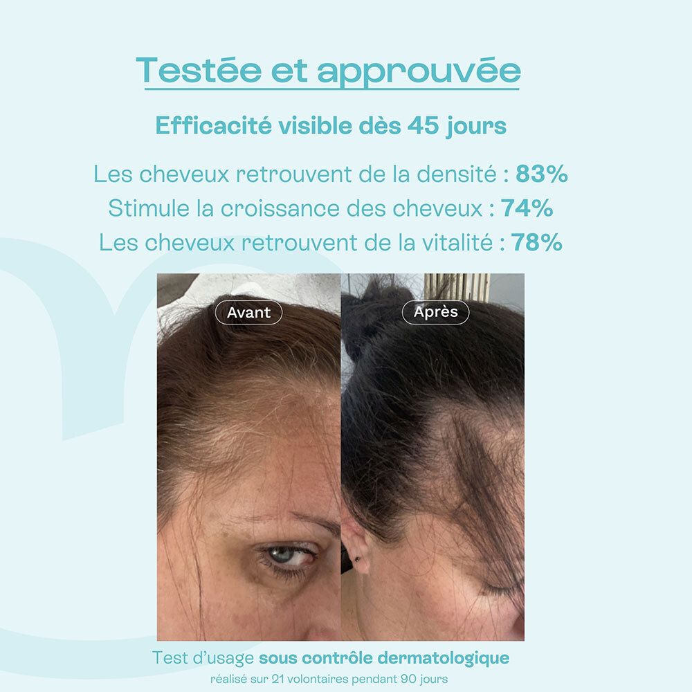 Image avant-après. Traitement de la chute de cheveux. Texte: Efficacité après 45 jours. 83% densité, 74% croissance, 78% vitalité.