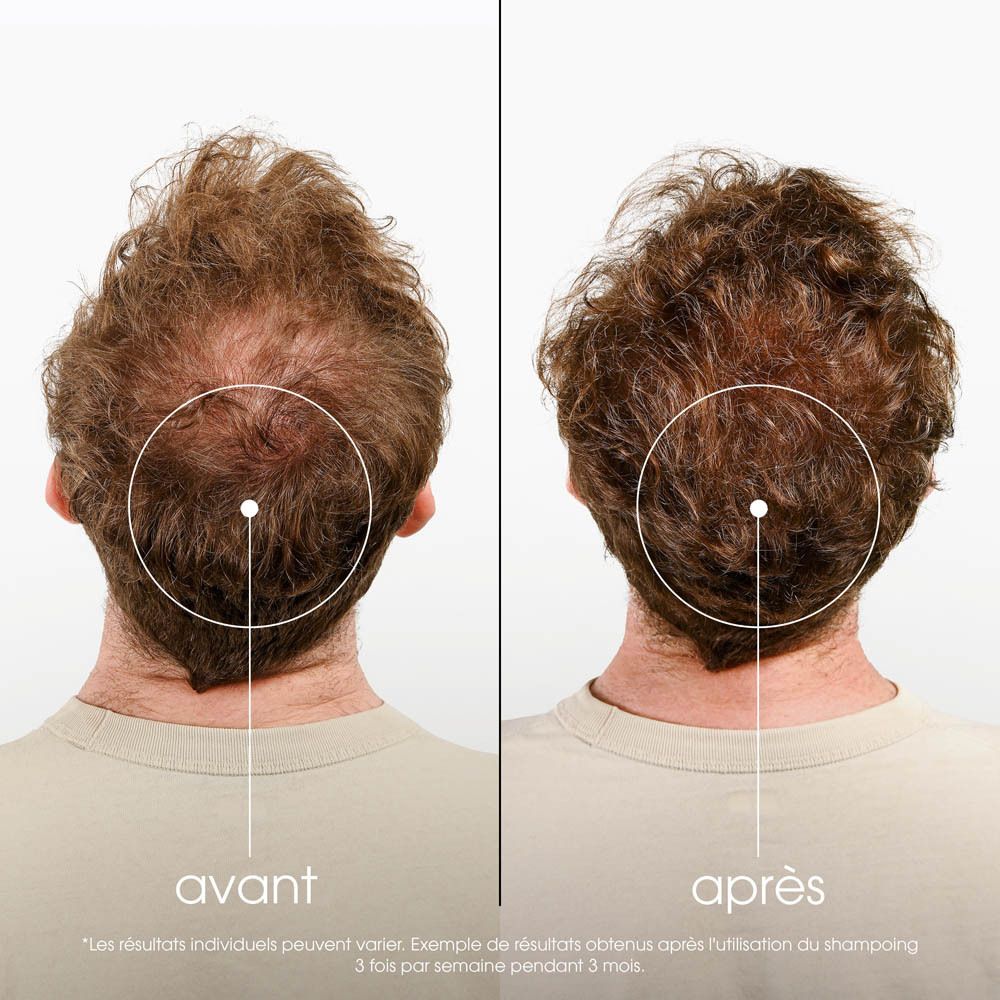 Image avant-après d'hommes avec perte de cheveux. Texte: avant, après.