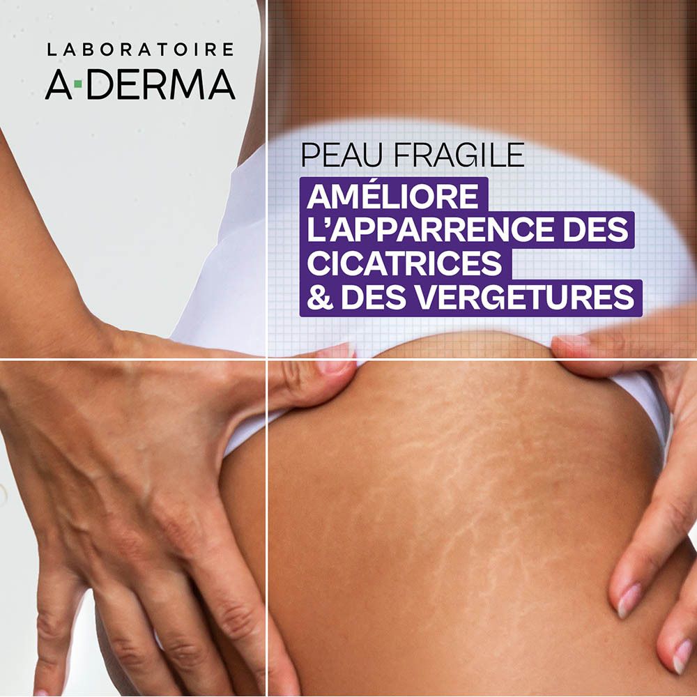 Gros plan sur cuisses avec vergetures. Texte: Améliore l'apparence des cicatrices.