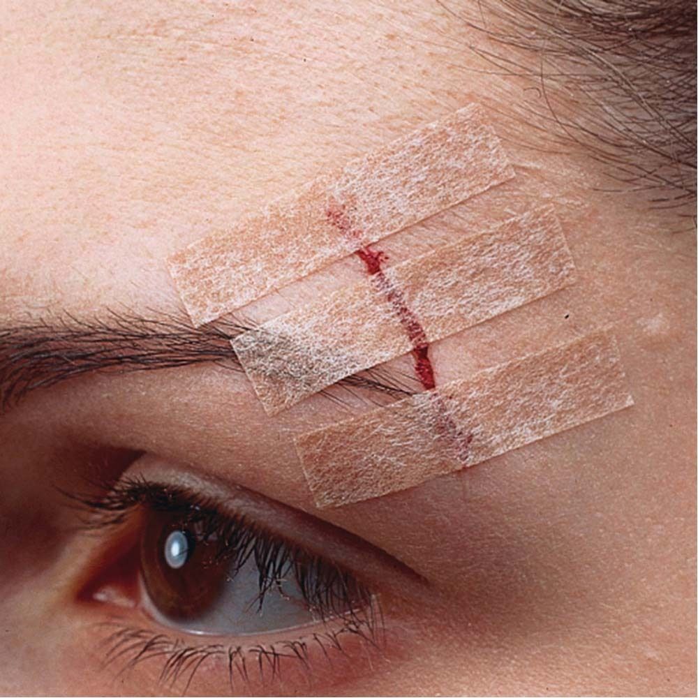 Verpackung mit Nexcare Steri-Strip Hautnahtmaterial. Enthält 6 Streifen. Größe: 6 mm x 75 mm. Hautfarben.