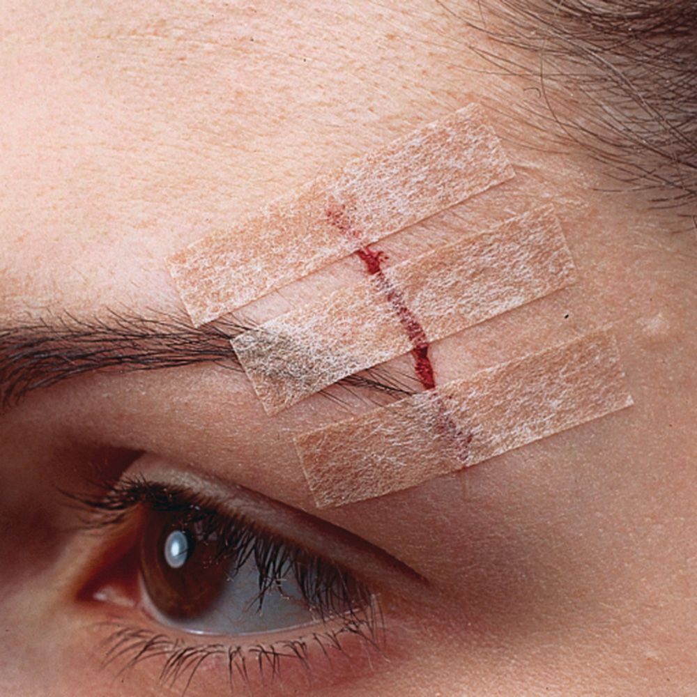 Nexcare™ Steri-Strip™ Hautnahtmaterial Hautfarbe 6 mm x 75 mm