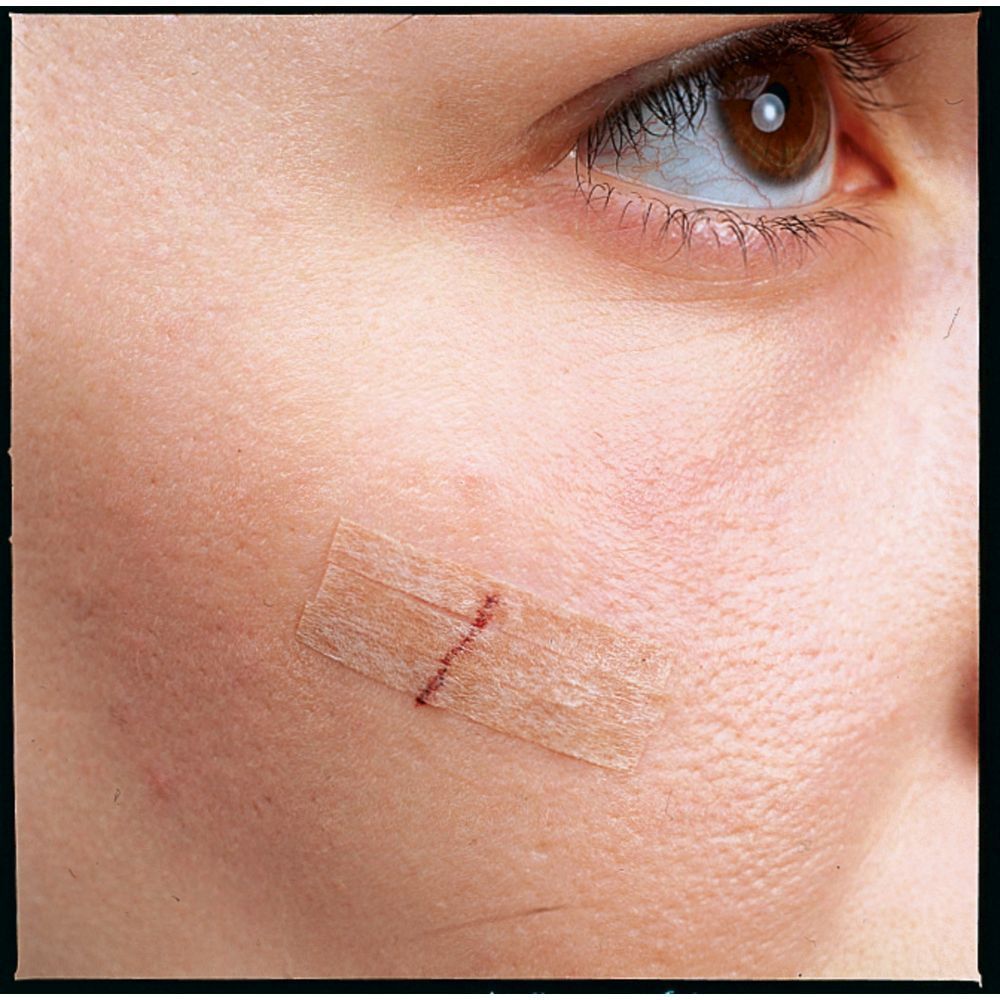 Nexcare™ Steri-Strip™ Hautnahtmaterial Hautfarbe 6 mm x 75 mm