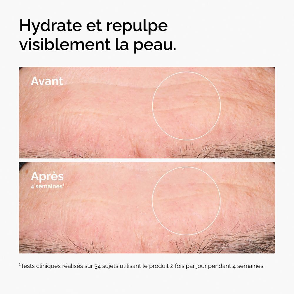 Comparaison avant-après. Peau ridée. Amélioration après 4 semaines.