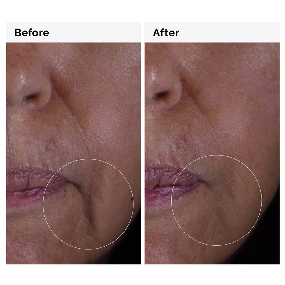 Comparaison avant-après. Zone de peau avec rides. Produit : The Ordinary GF 15% Solution Serum.