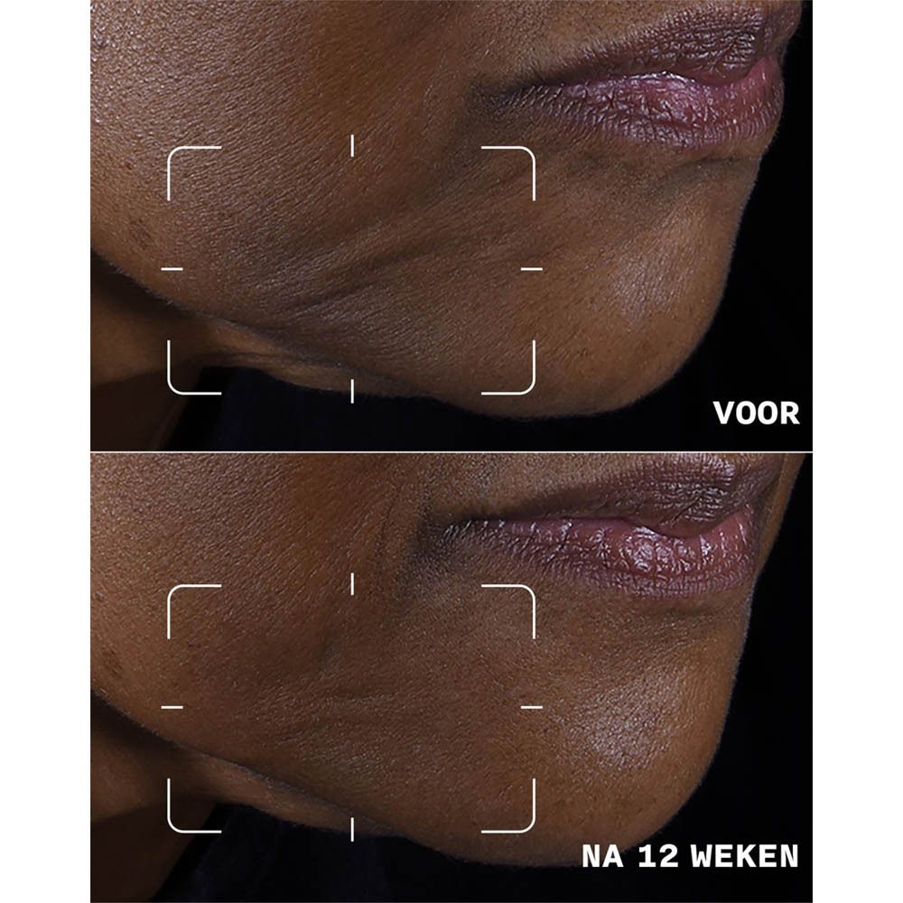 Comparaison avant-après. Rides autour de la bouche avant et après 12 semaines. La peau semble plus lisse.