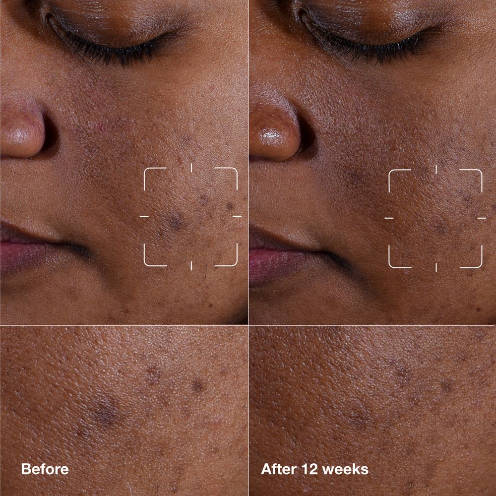 Zones de peau avant et après 12 semaines. Taches sombres réduites. Nom de la marque ou du produit non visible.