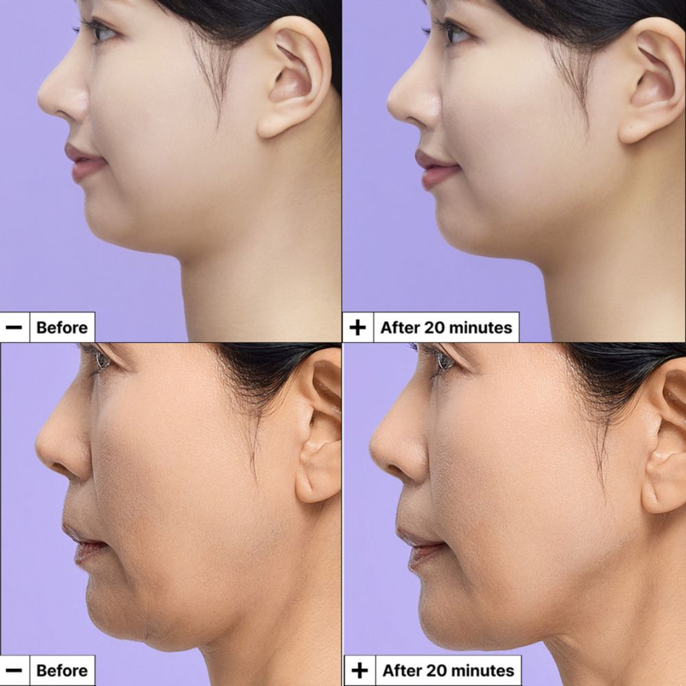 Vorher-Nachher-Vergleich des Kiefers einer Frau nach Anwendung der Dr. Jart+ Cryo-V Kinnlinien-Lifting-Maske.