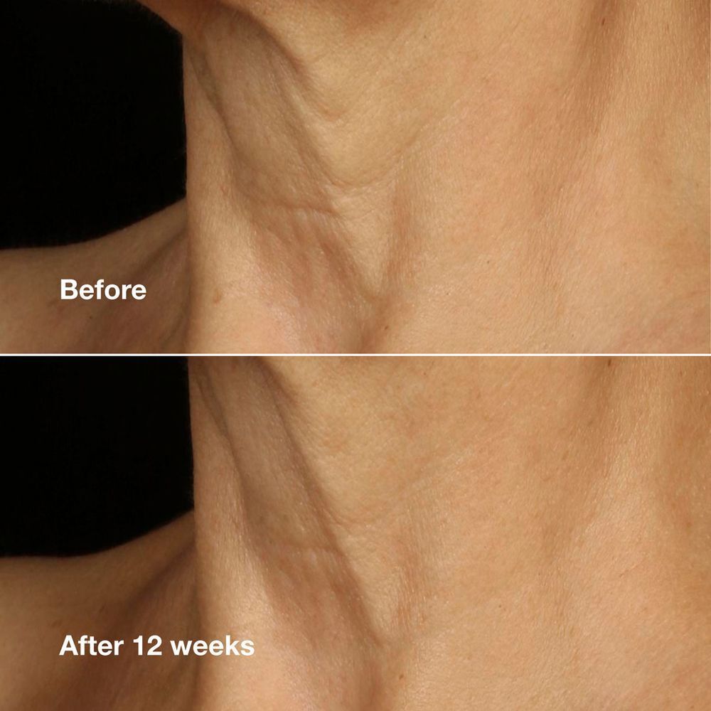 Comparaison avant-après de la peau du cou montrant l'effet de Clinique Smart Clinical Repair.