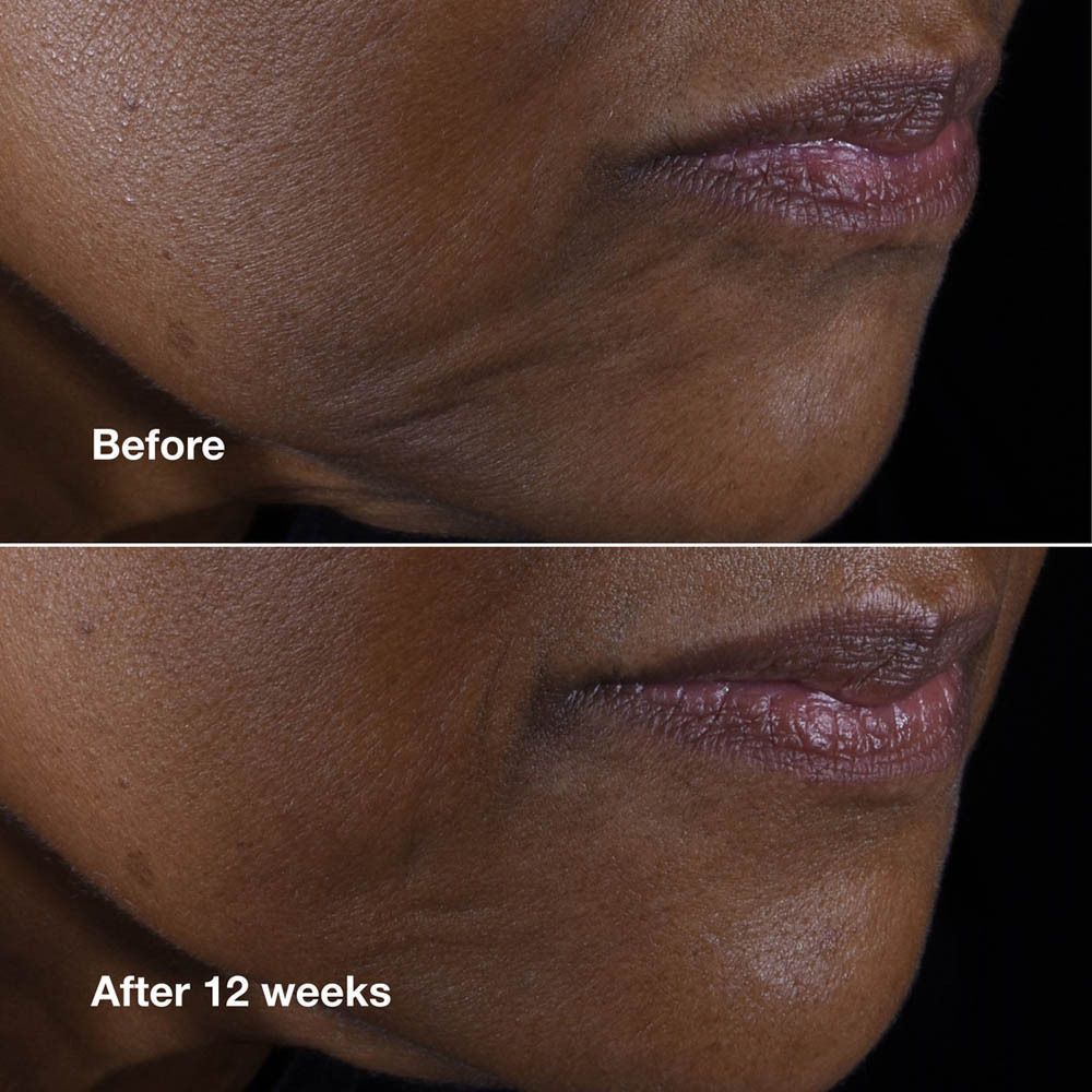 Comparaison avant-après de la peau du menton montrant l'effet de Clinique Smart Clinical Repair.