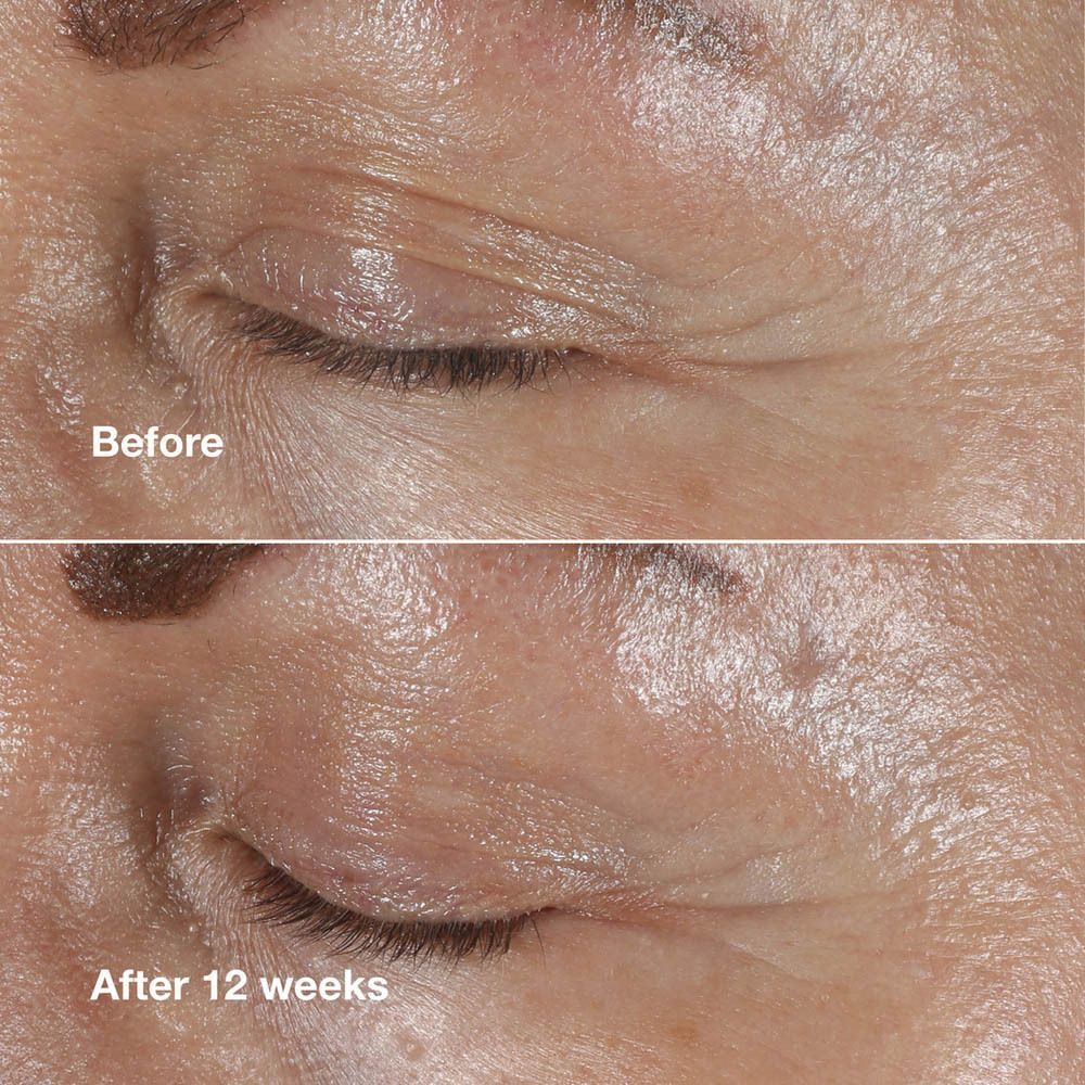 Vorher-Nachher-Vergleich der Augenpartie einer Frau, die Falten zeigt.