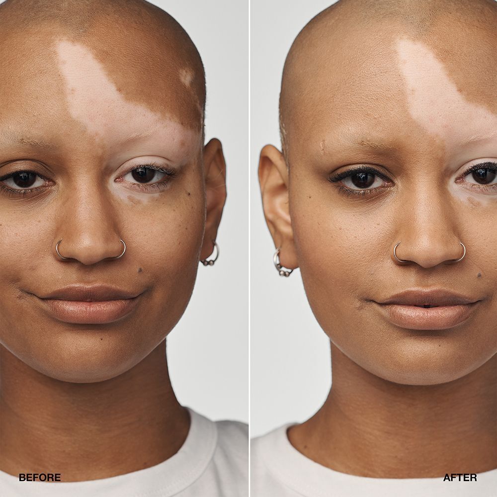 Comparaison avant/après d'une personne atteinte de vitiligo portant le fond de teint sérum CLINIQUE Even Better Clinical SPF 20.