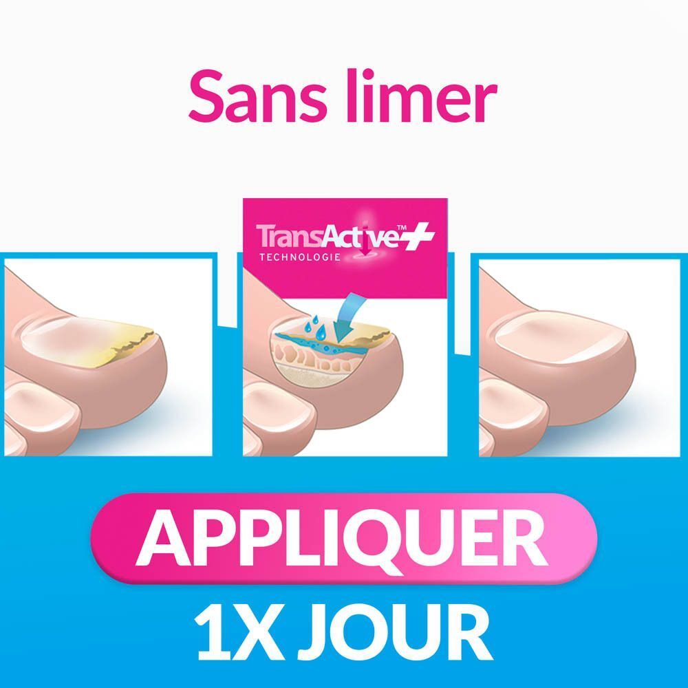 Comparaison avant/après d'un ongle sain et d'un ongle infecté.