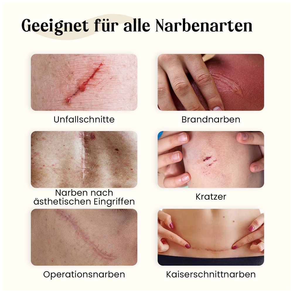 Dermatix Ultra Gel. Convient aux cicatrices d'accident, de brûlure, d'opération et de césarienne. Image de cicatrices.