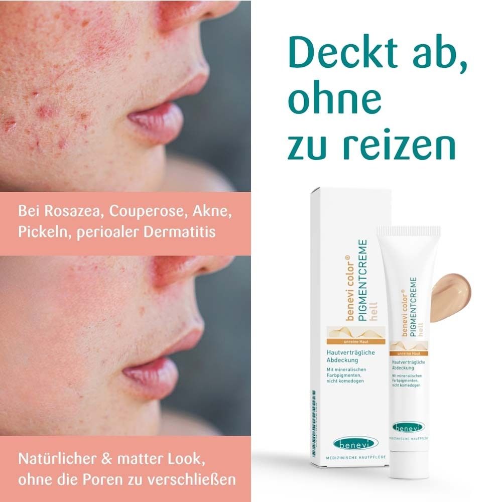 Gesichtsbilder mit Hautunreinheiten. Daneben Tube und Verpackung von benevi color Pigmentcreme hell.