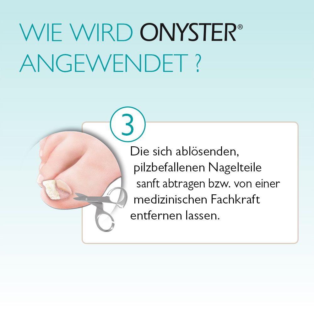 Onyster® Set ongles