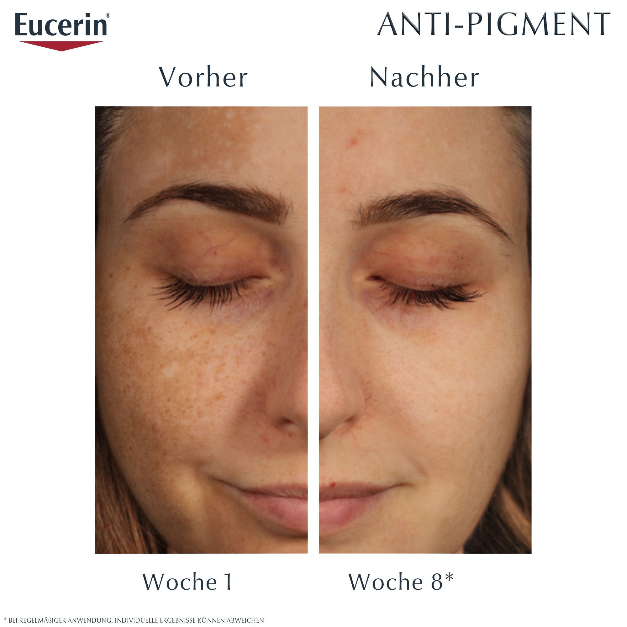 Gesicht mit Pigmentflecken, Vorher-Nachher-Vergleich. Nach 8 Wochen deutliche Verbesserung. Text: Anti-Pigment.
