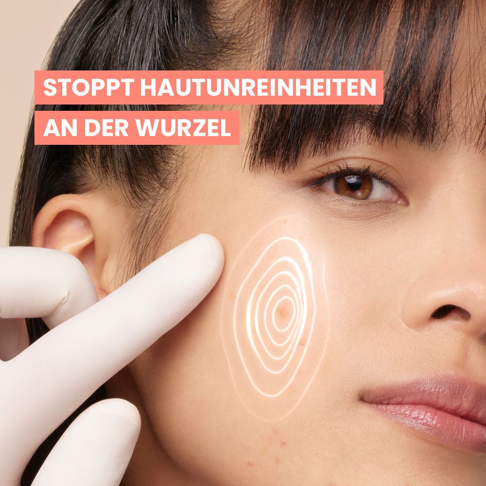 Nahaufnahme eines Gesichts mit einem Finger in einem weißen Handschuh, der auf eine Hautunreinheit zeigt. Konzentrische Linien visualisieren die Behandlung.
