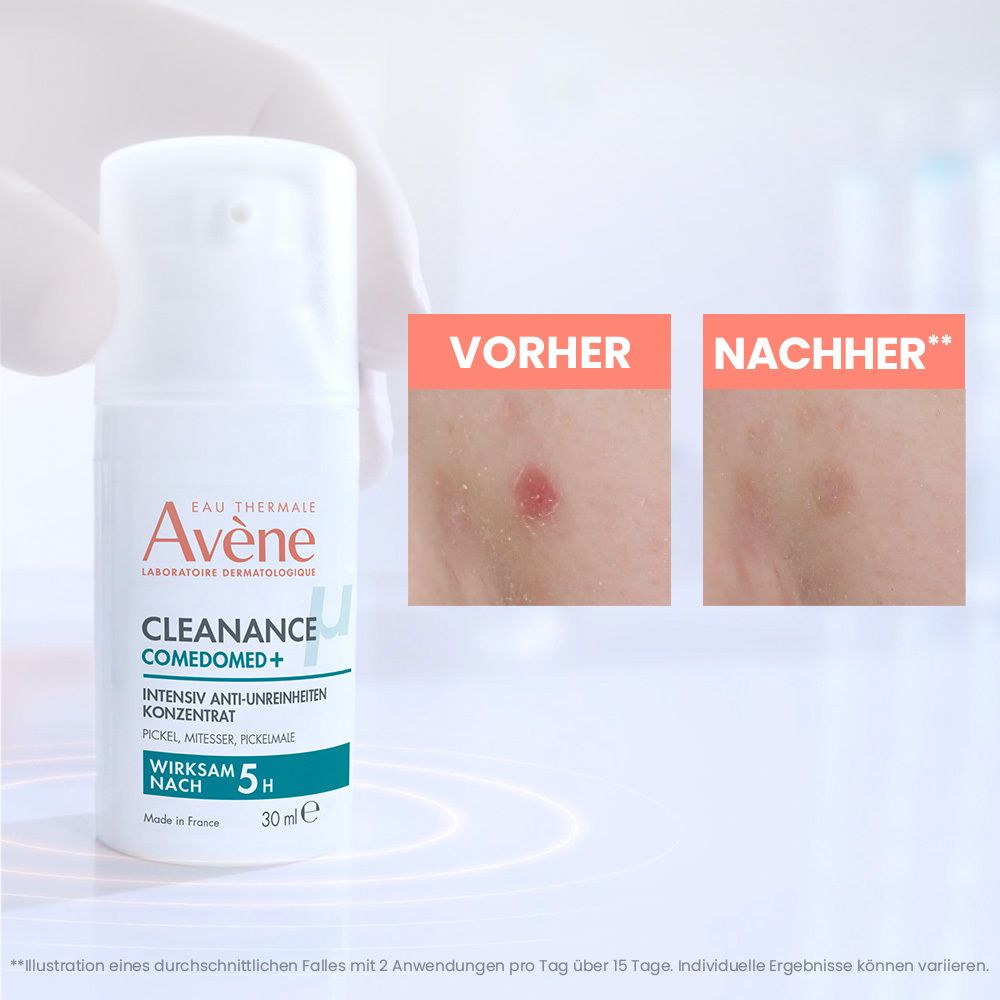 Avene Cleanance Comedomed+ Flasche mit 30ml Inhalt. Vorher/Nachher-Bilder von Hautunreinheiten.