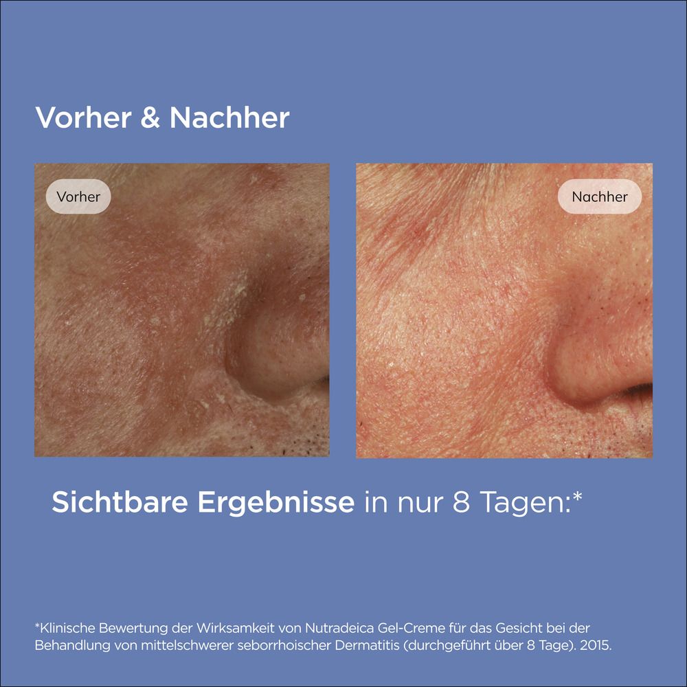 ISDIN Nutradeica® Gel-Creme beruhigende Gesichtscreme gegen Juckreiz, Schuppung und Rötung speziell bei seborrhoischer Dermatitis