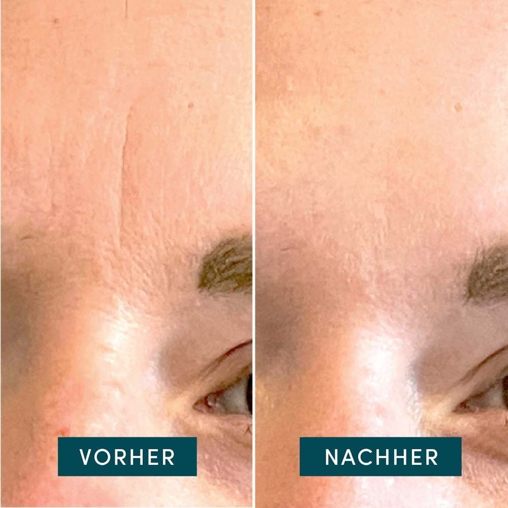 Comparaison avant-après de la peau. Libellé : Avant, Après.