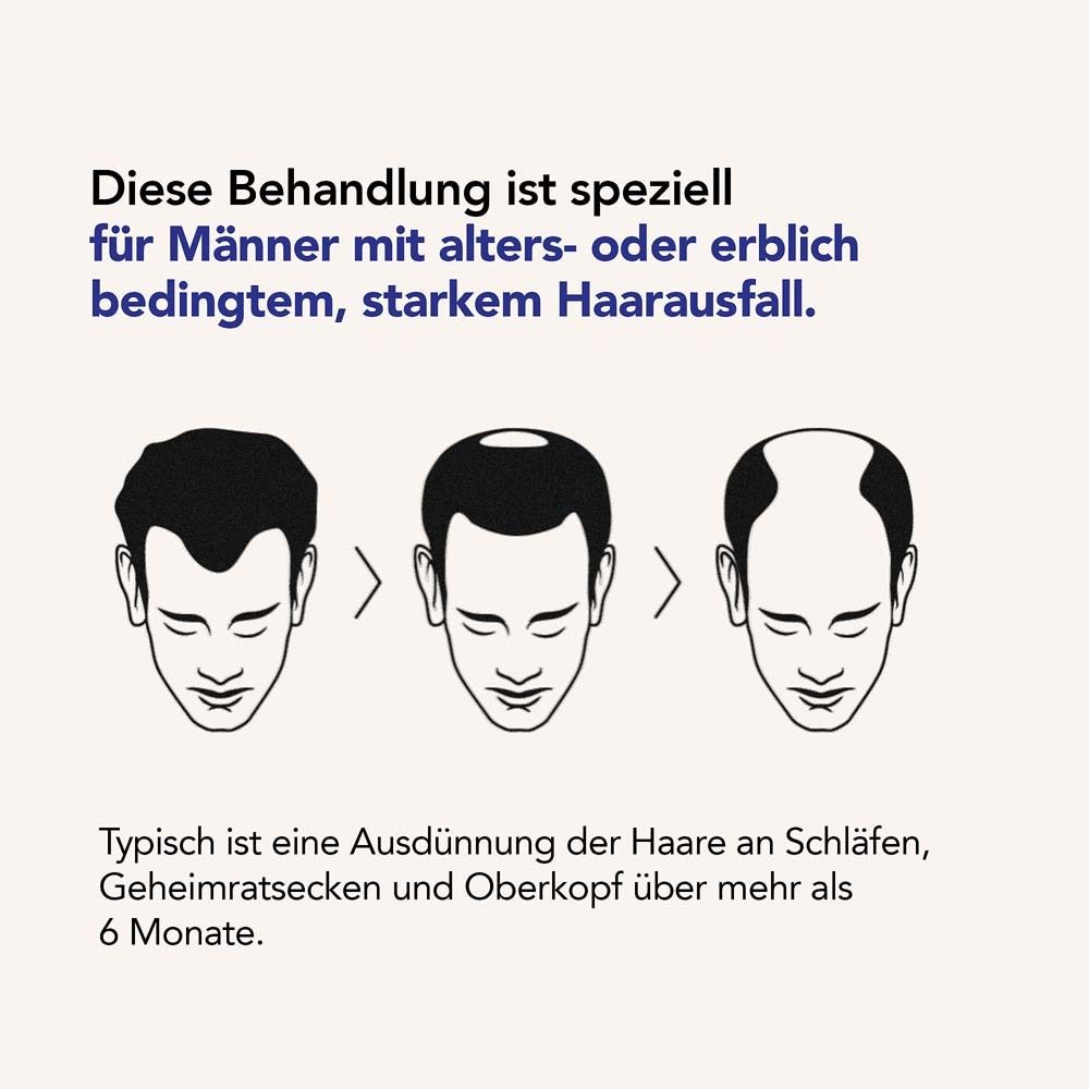 Illustrationen von Haarausfallstadien. Text: Diese Behandlung ist speziell für Männer mit Haarausfall.