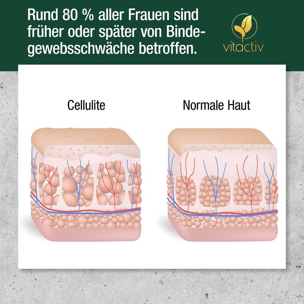 Vergleich Cellulite und normale Haut. Grafische Darstellung der Hautschichten.