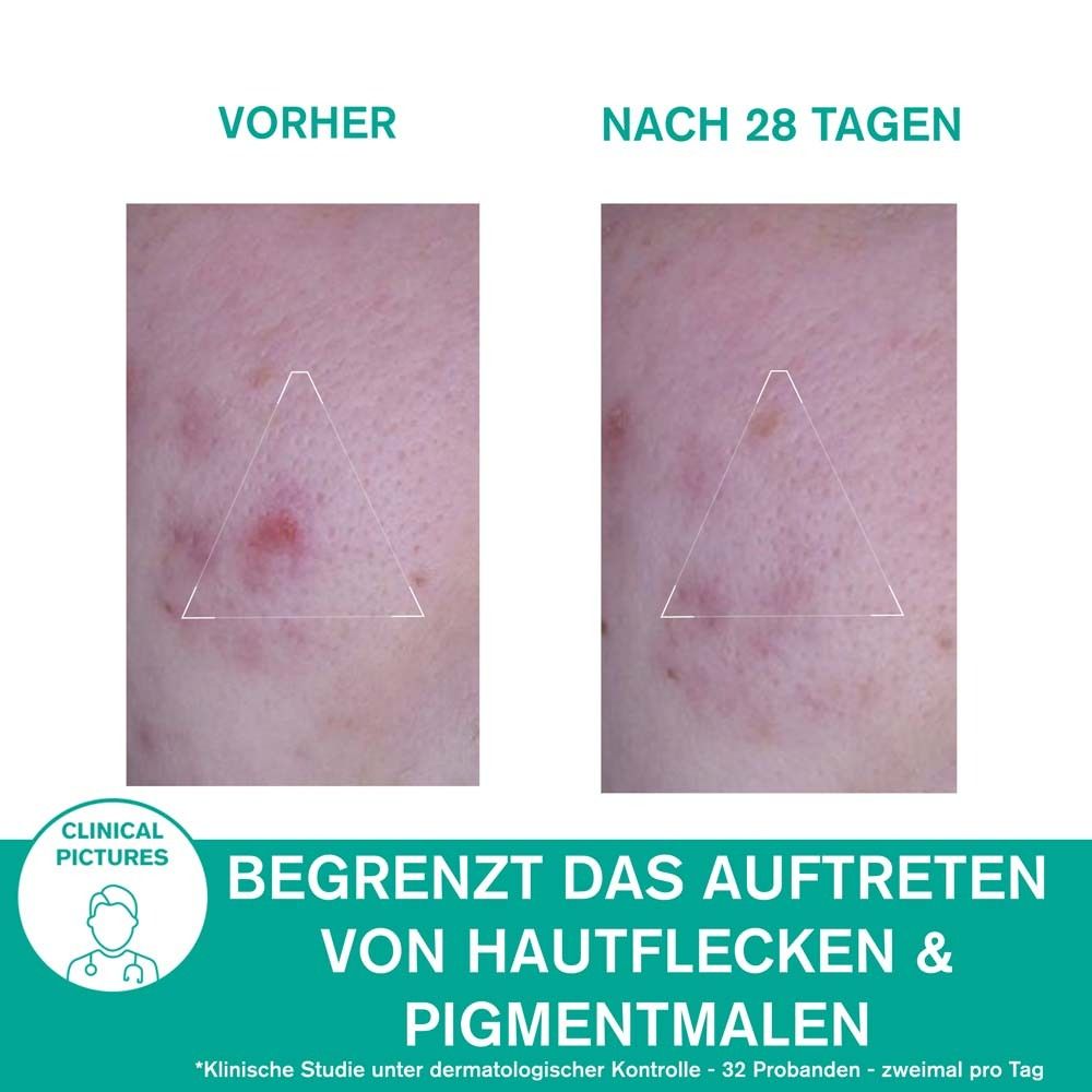 Vorher-Nachher-Vergleich. Haut mit Unreinheiten. Text: Begrenzt Hautflecken & Pigmentmale. Klinische Bilder.