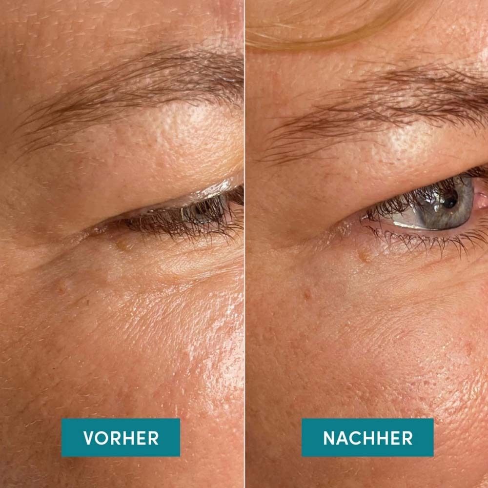 Comparaison avant-après. Gauche : peau ridée. Droite : peau plus lisse. Produit : Eye Temple Pads.