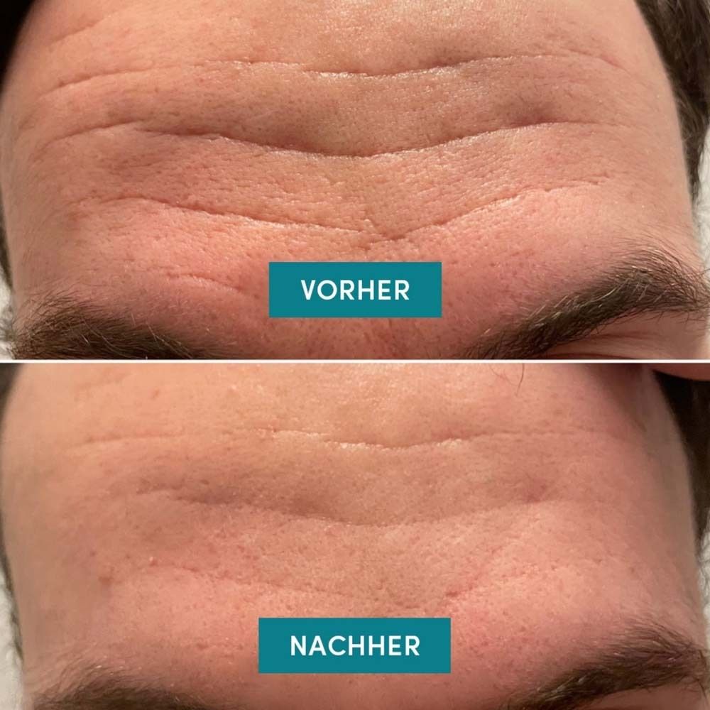 Vorher-Nachher-Vergleich. Stirn mit Falten. Nachher: glattere Haut. Text: Vorher/Nachher.