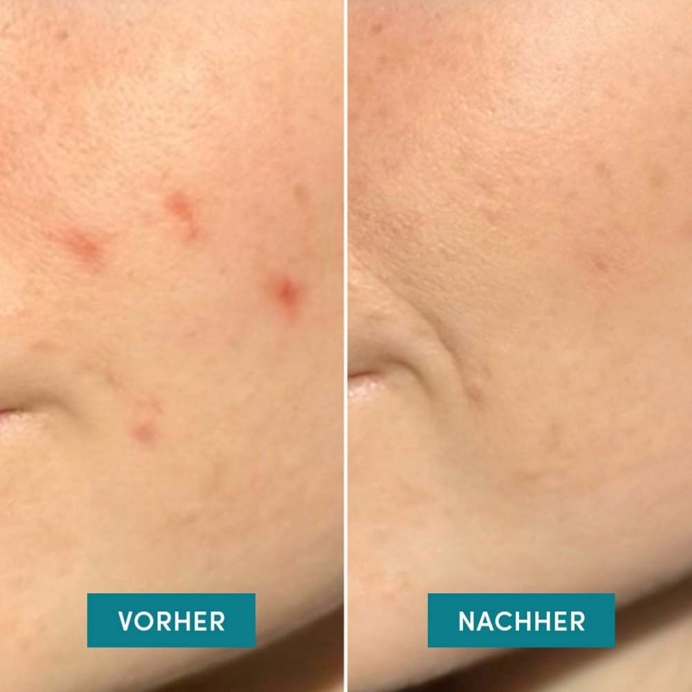 Comparaison avant-après. Peau avec boutons vs. peau après application de patchs anti-boutons.