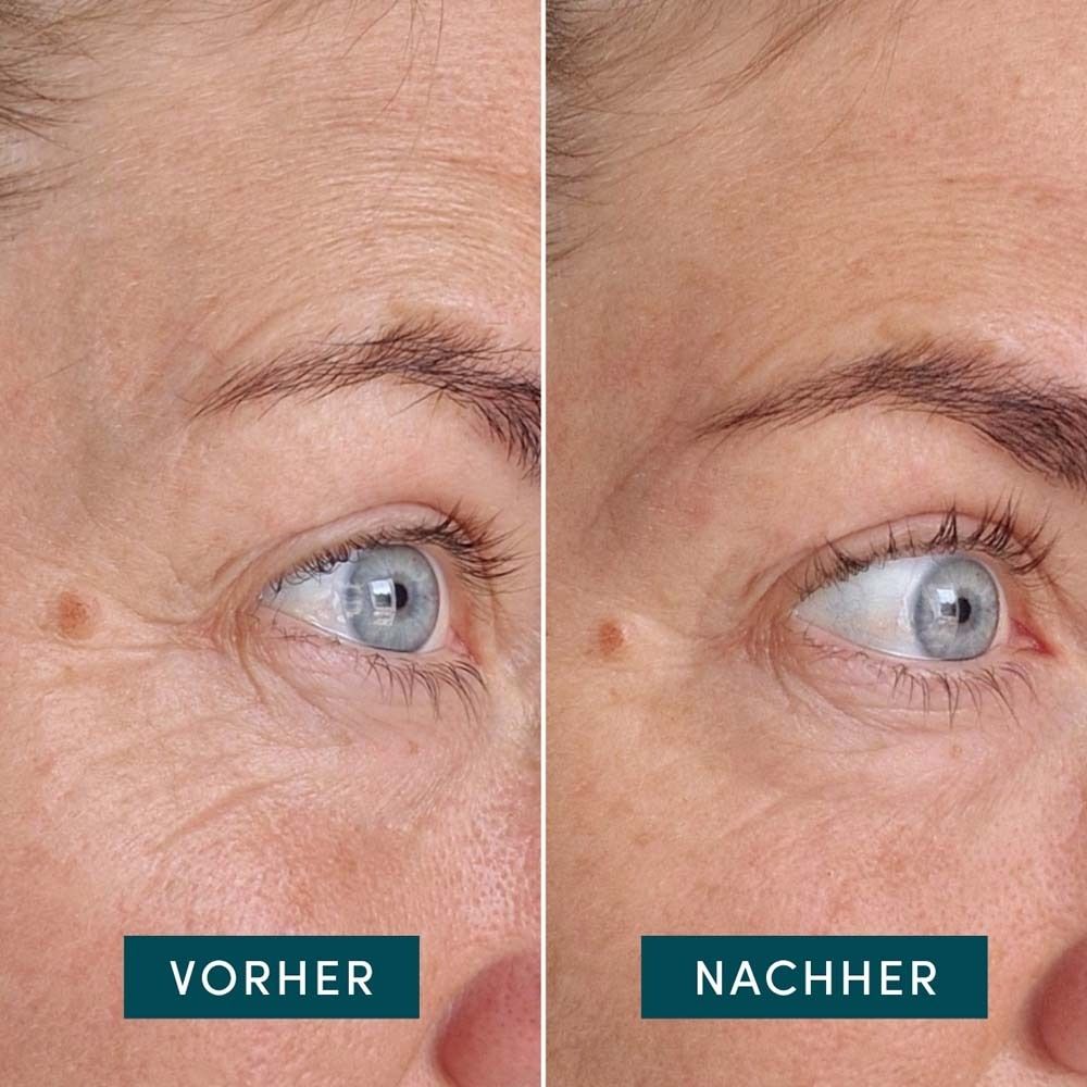 Vorher-Nachher-Vergleich von Augenpartien. Links: Falten. Rechts: Weniger Falten. Text: Vorher, Nachher.
