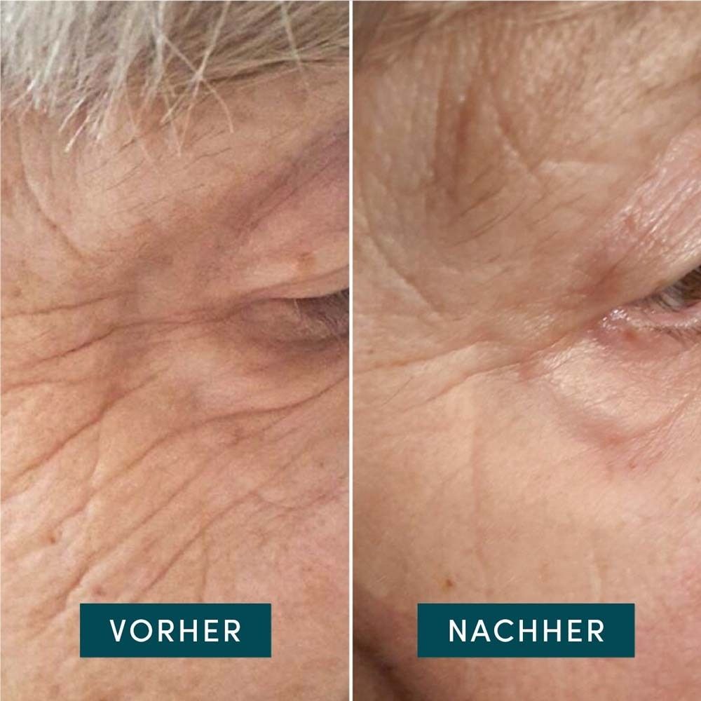 Vorher-Nachher-Vergleich. Hautpartie mit Falten. Nachher: Haut wirkt glatter. Beschriftung: Vorher, Nachher.