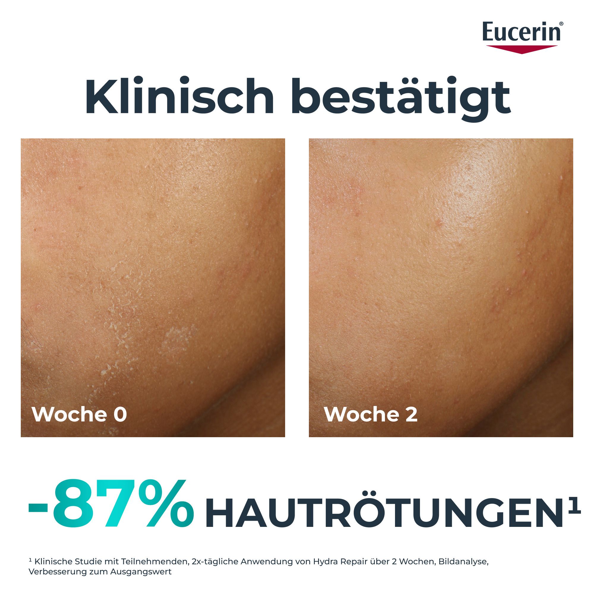 Gesicht mit Hautunreinheiten. Vorher-Nachher-Vergleich. Text: -87% Hautrötungen. Klinisch bestätigt.