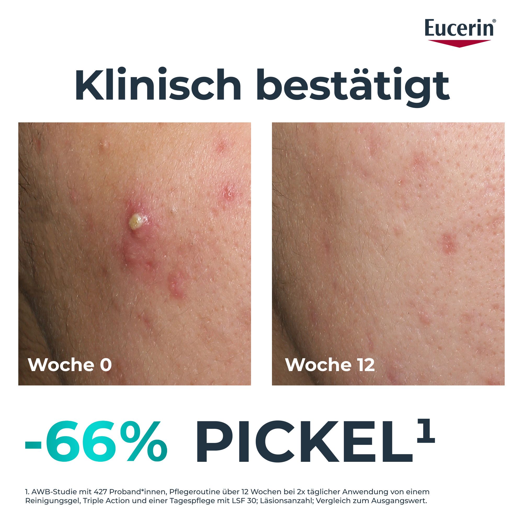 Vorher-Nachher-Bild. Haut mit Pickeln (Woche 0) und verbesserte Haut (Woche 12). Text: -66% Pickel.