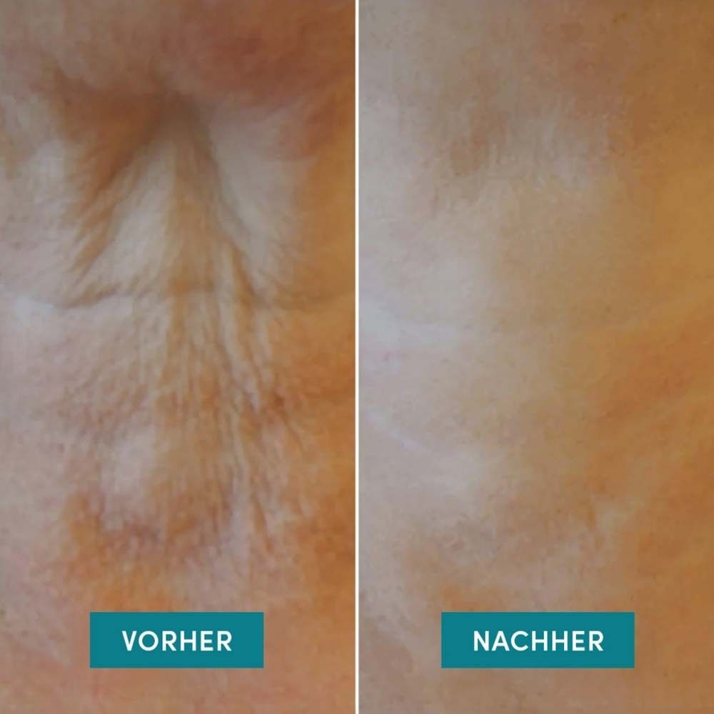 Vergleichsbild: Vorher-Nachher-Effekt. Hautpartie mit Falten (vorher) und glatter Haut (nachher).