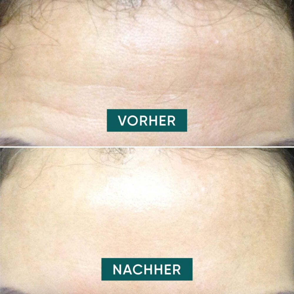 Vorher-Nachher-Vergleich. Stirn mit Falten. Nachher: Glatte Stirn. Grüne Textfelder.
