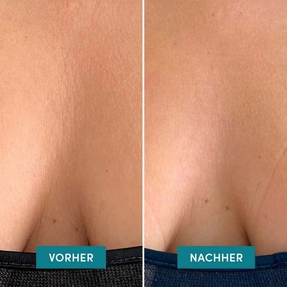 Comparaison avant-après : décolleté ridé, puis plus lisse.