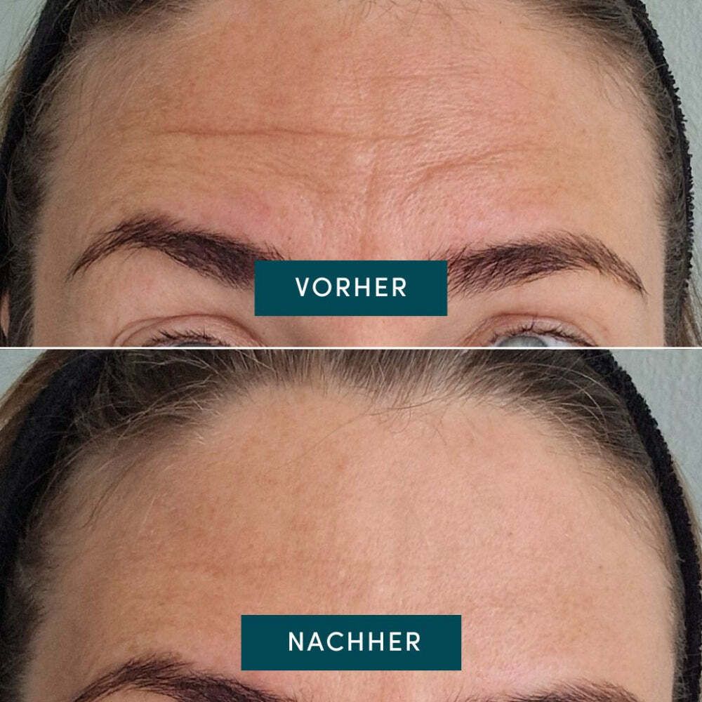 Vorher-Nachher-Vergleich. Zwei Fotos von Stirnfalten. Oben: Vorher. Unten: Nachher. Text in Türkis.