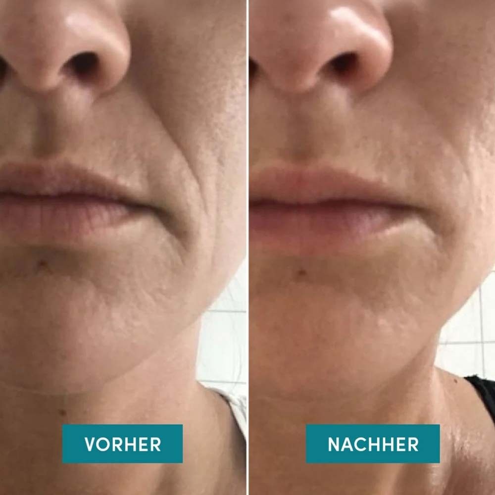 Vorher-Nachher-Vergleich von Lippen. Links: Falten. Rechts: Glattere Haut. Text: Vorher, Nachher.