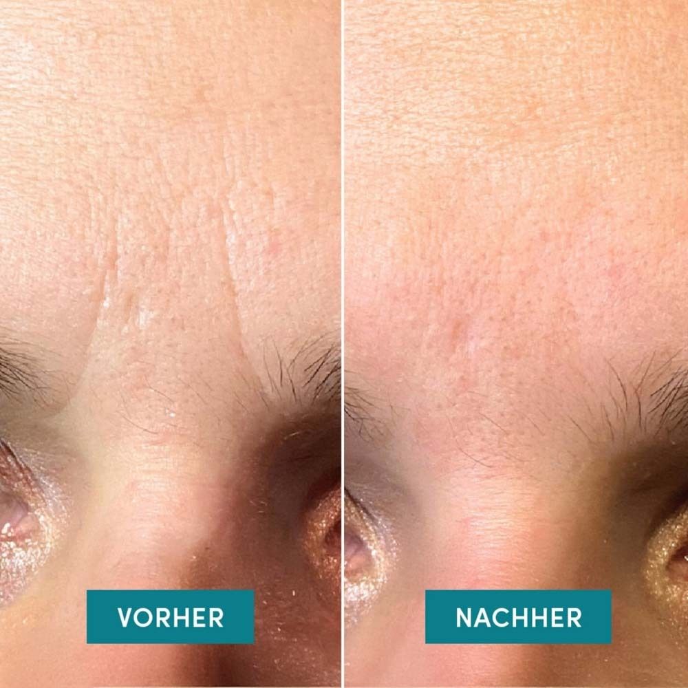 Comparaison avant-après du front. Gauche : rides. Droite : peau lisse. Nom du produit non visible.