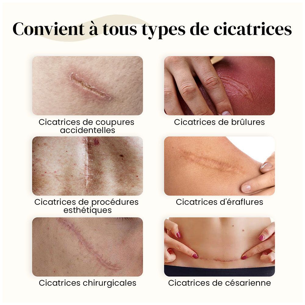 Images de différents types de cicatrices: coupures, brûlures, interventions esthétiques, éraflures, cicatrices chirurgicales, césariennes.