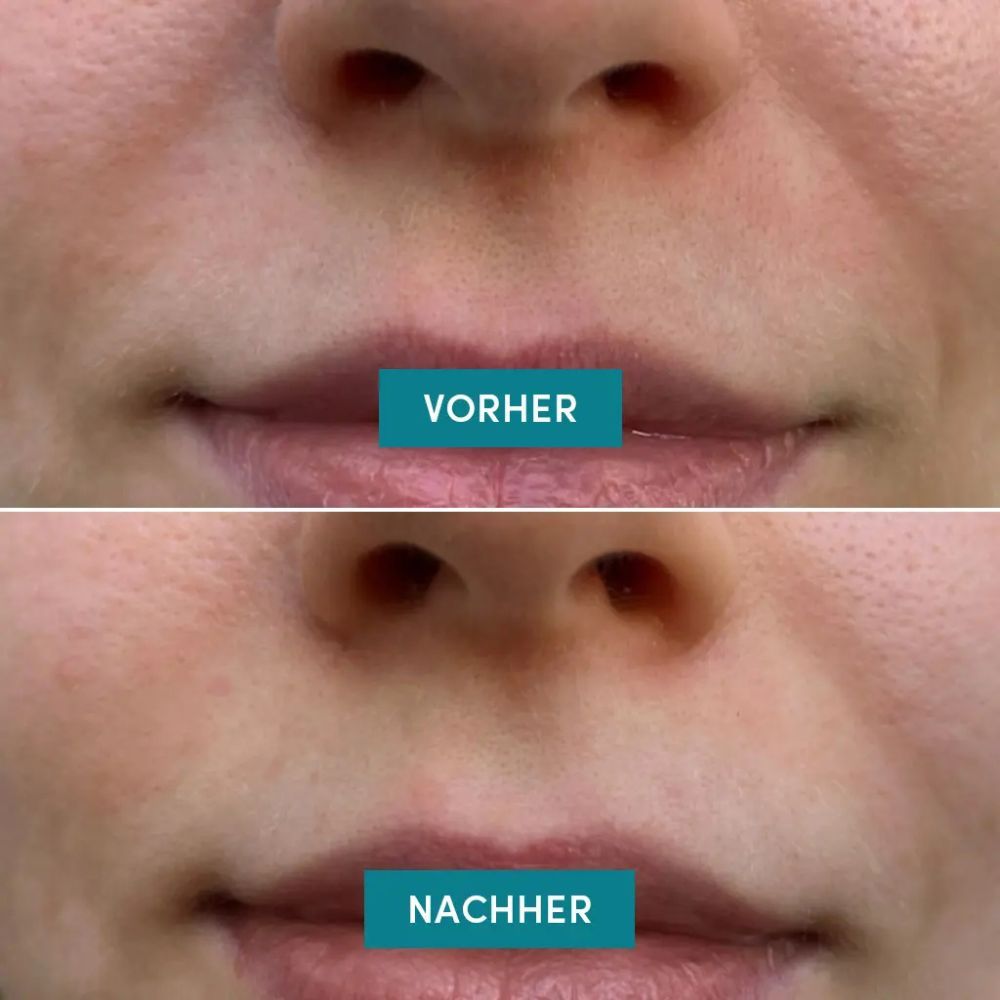 Vorher-Nachher-Vergleich von Lippen. Obere Lippenpartie: Vorher. Untere Lippenpartie: Nachher. Hautbild.