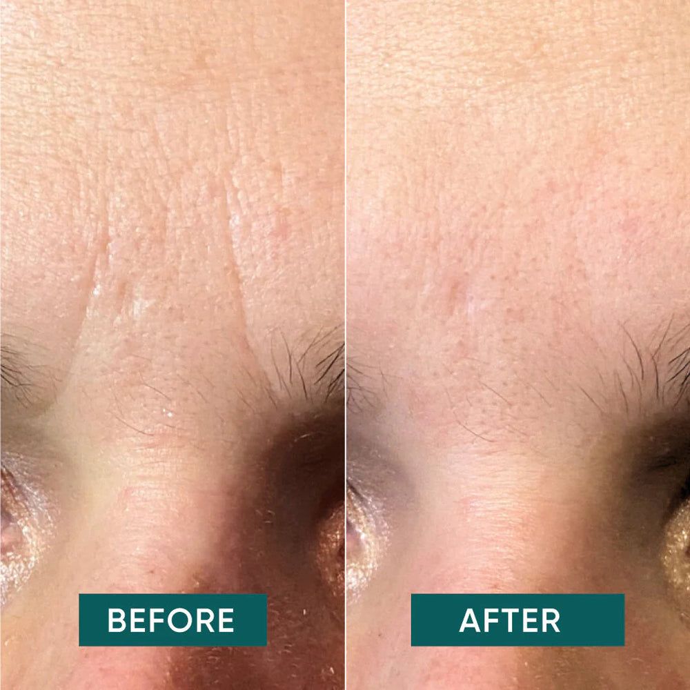 Gros plan sur les rides du front. Comparaison avant-après. Texte: BEFORE et AFTER. Peau ridée et peau lisse.