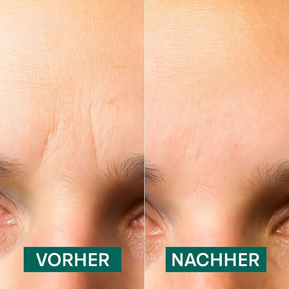 Vorher-Nachher-Vergleich von Haut. Beschriftung: Vorher, Nachher. Haut mit Falten, dann glatt.